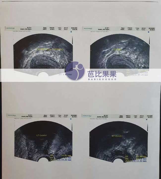 泰国试管代妈体检达标