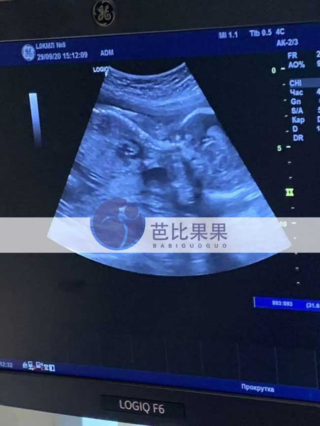 乌克兰试管代妈做产检