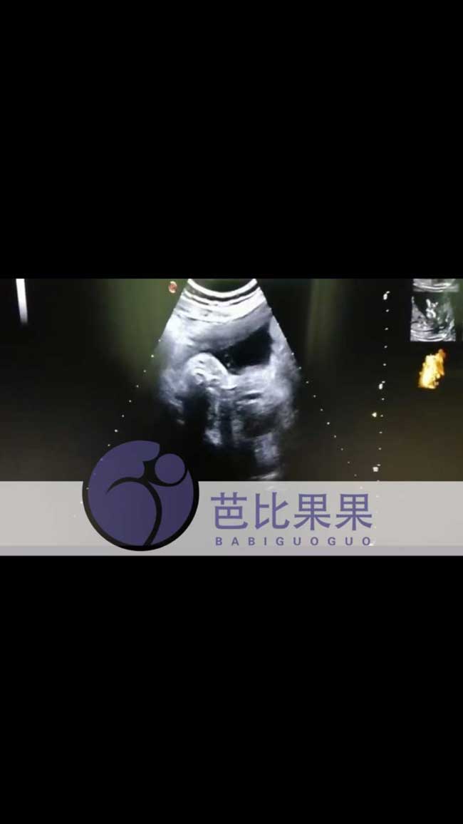 乌克兰代妈试管怀孕33周孕检