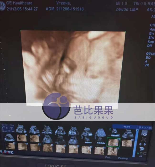 乌克兰孕妈四维彩超检查