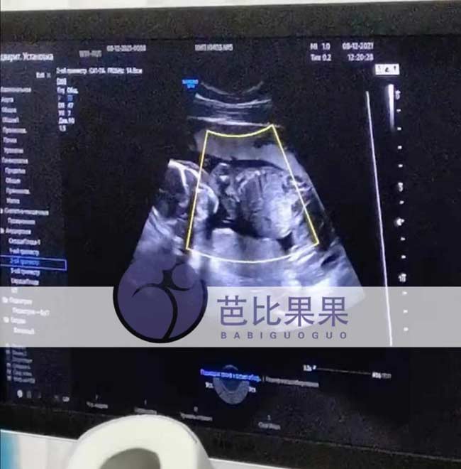 乌克兰孕38周孕妈做B超