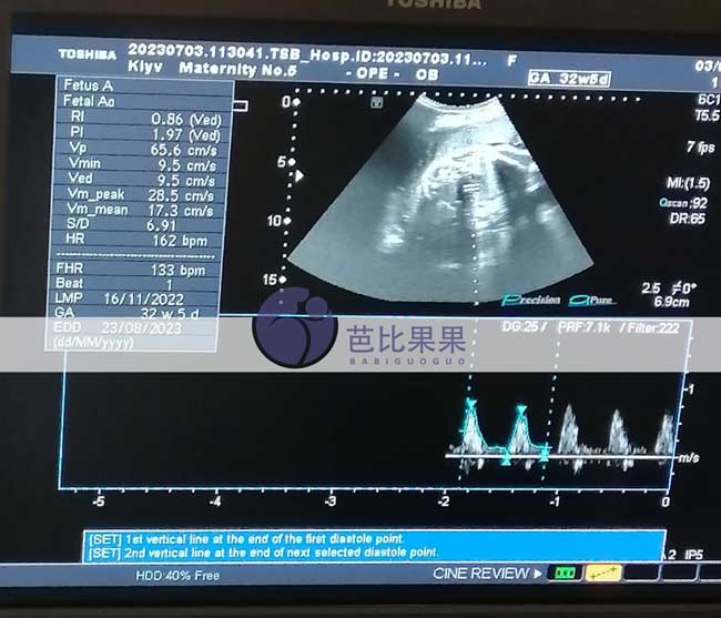 乌克兰试管妈妈孕32周B超