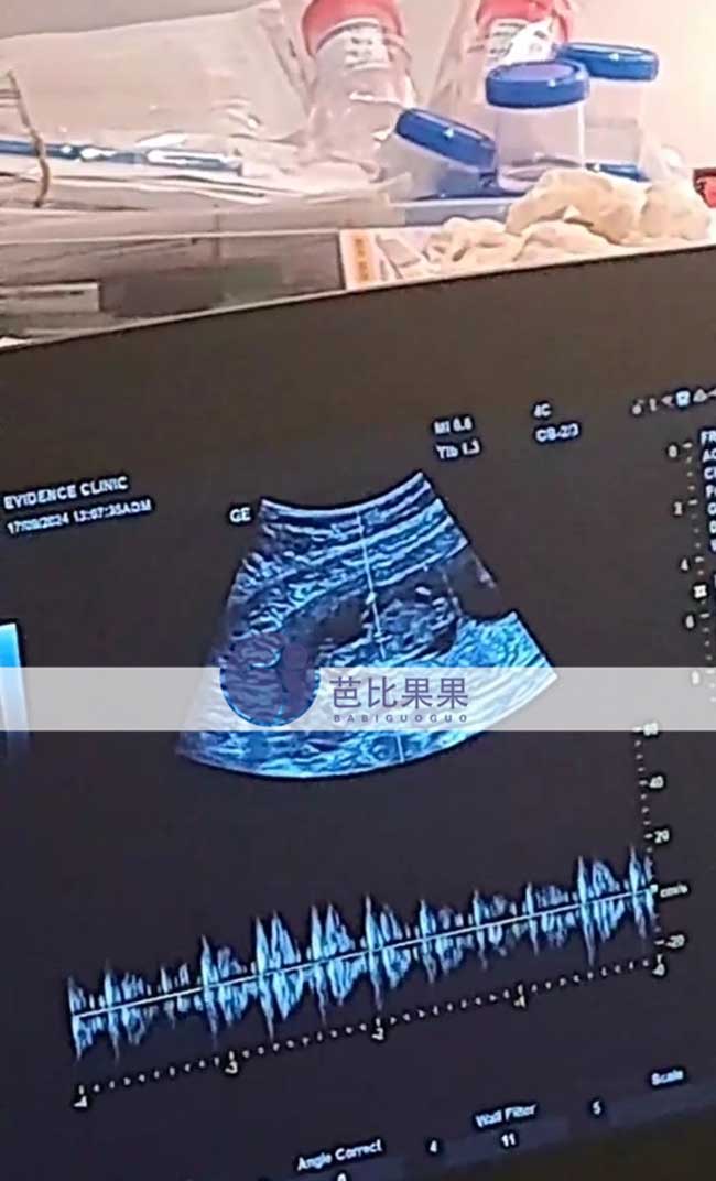 乌克兰试管妈妈孕12周B超