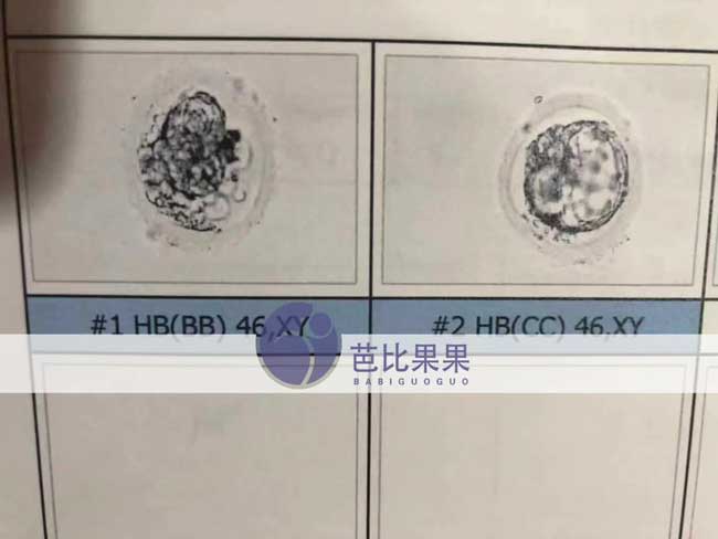 泰国爱宝贝试管移植